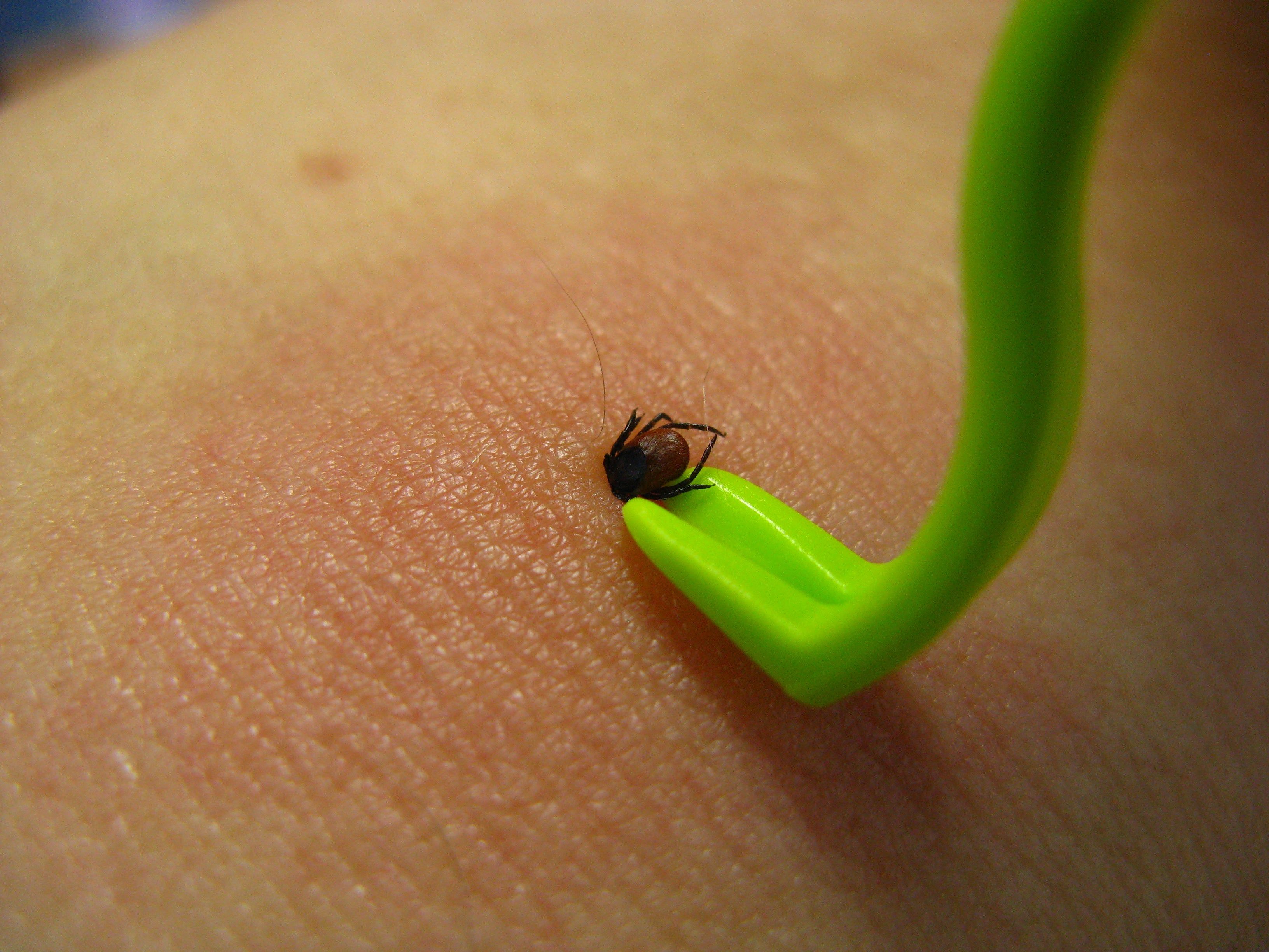 Grünes Werkzeug entfernt Zecke von menschlicher Haut. Zecke ist am Werkzeug befestigt.