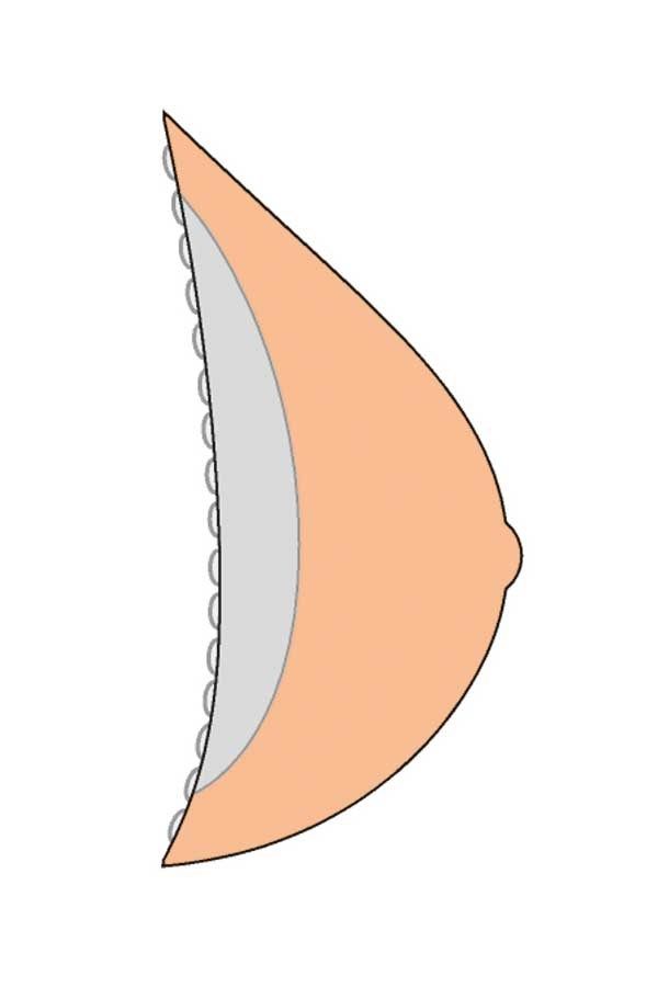 Grafische Darstellung einer Brustprothese in mittlerer Brustform. Hautfarben, mit abgerundeten Kanten und einer angedeuteten Noppenstruktur.