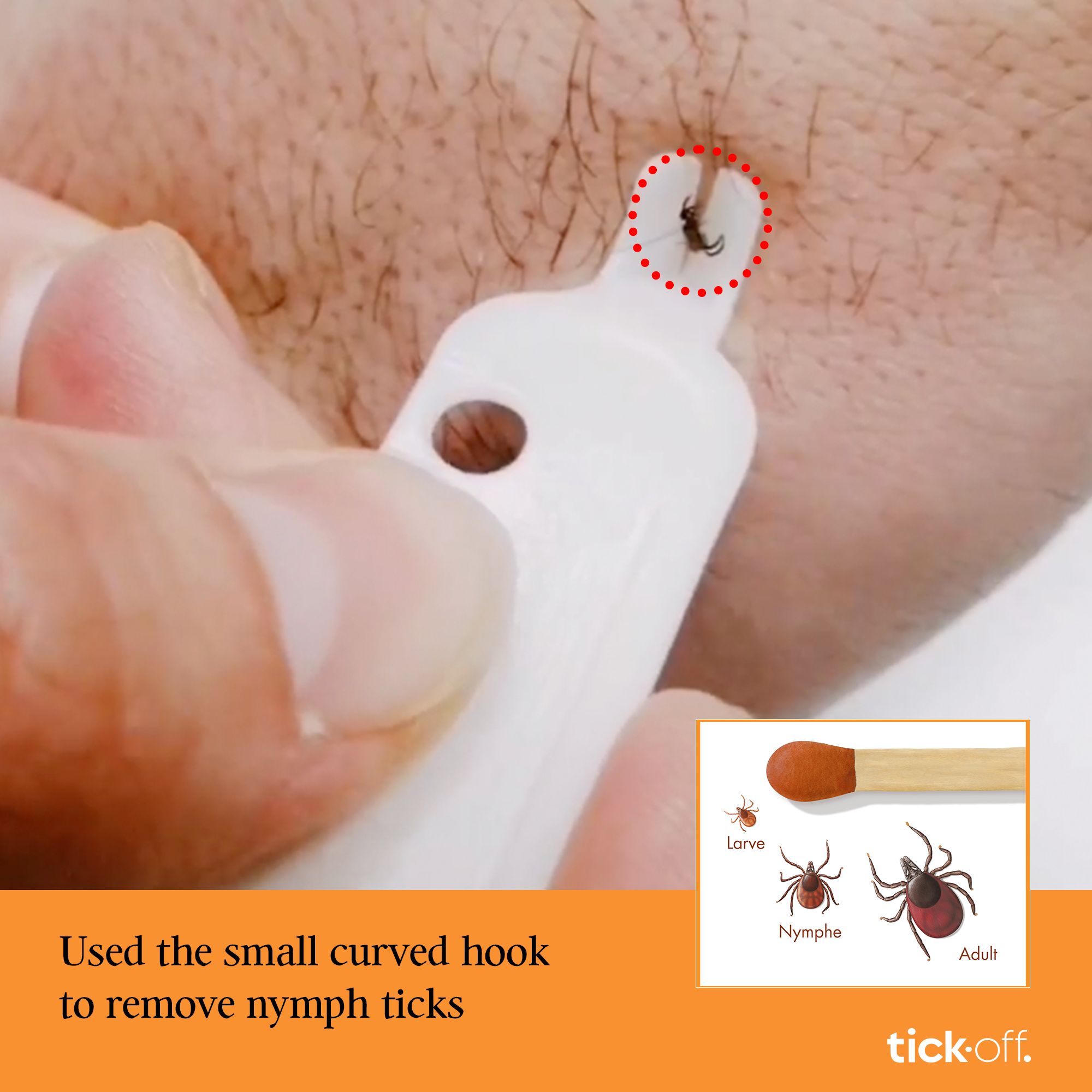 Person verwendet Tick-off Zeckenentferner. Zecke am Arm. Illustrationen von Zeckenstadien.