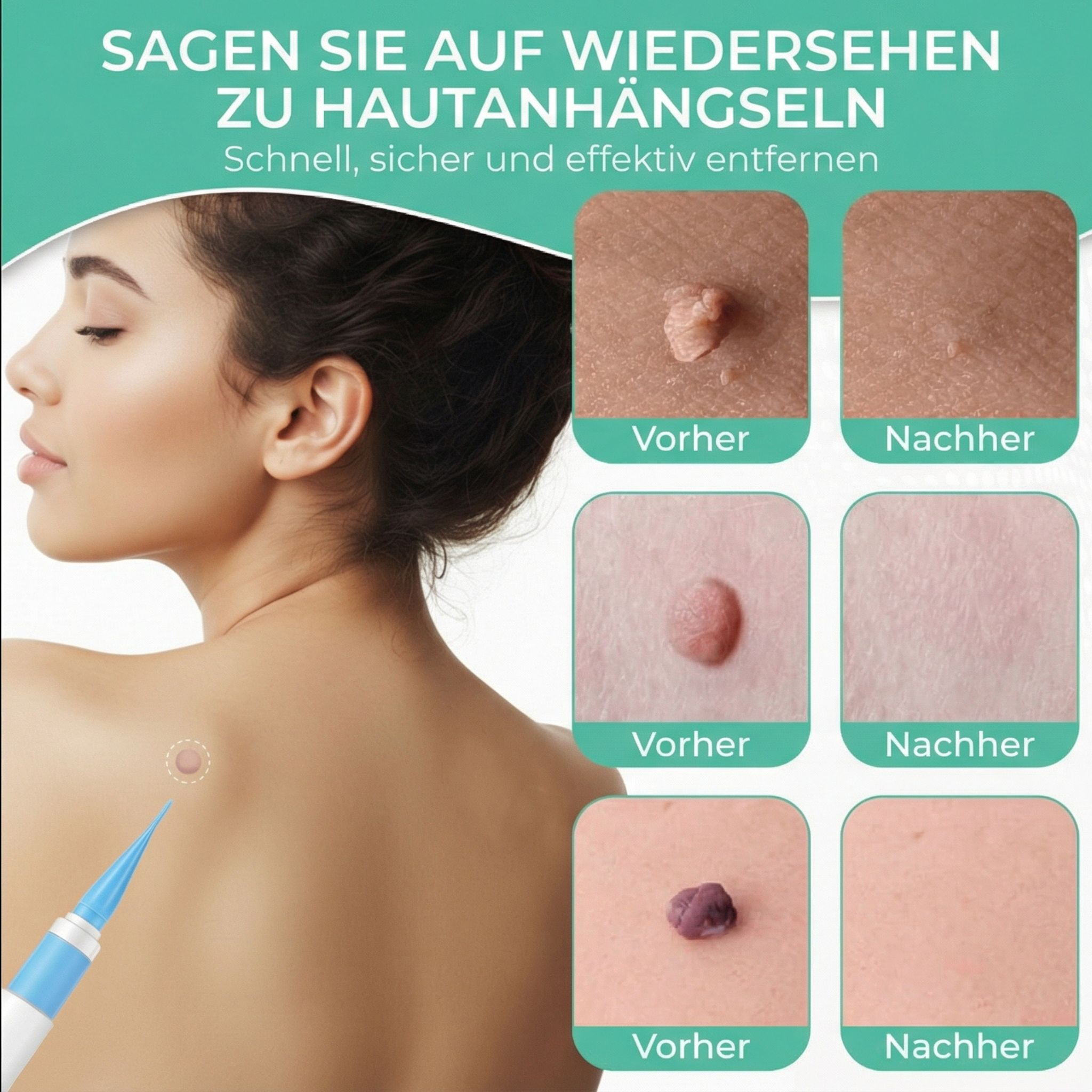 Vorher-Nachher-Bilder von Hautanhängseln am Rücken, Gesicht, Hals. Entfernung mit Leiqier-Gerät.