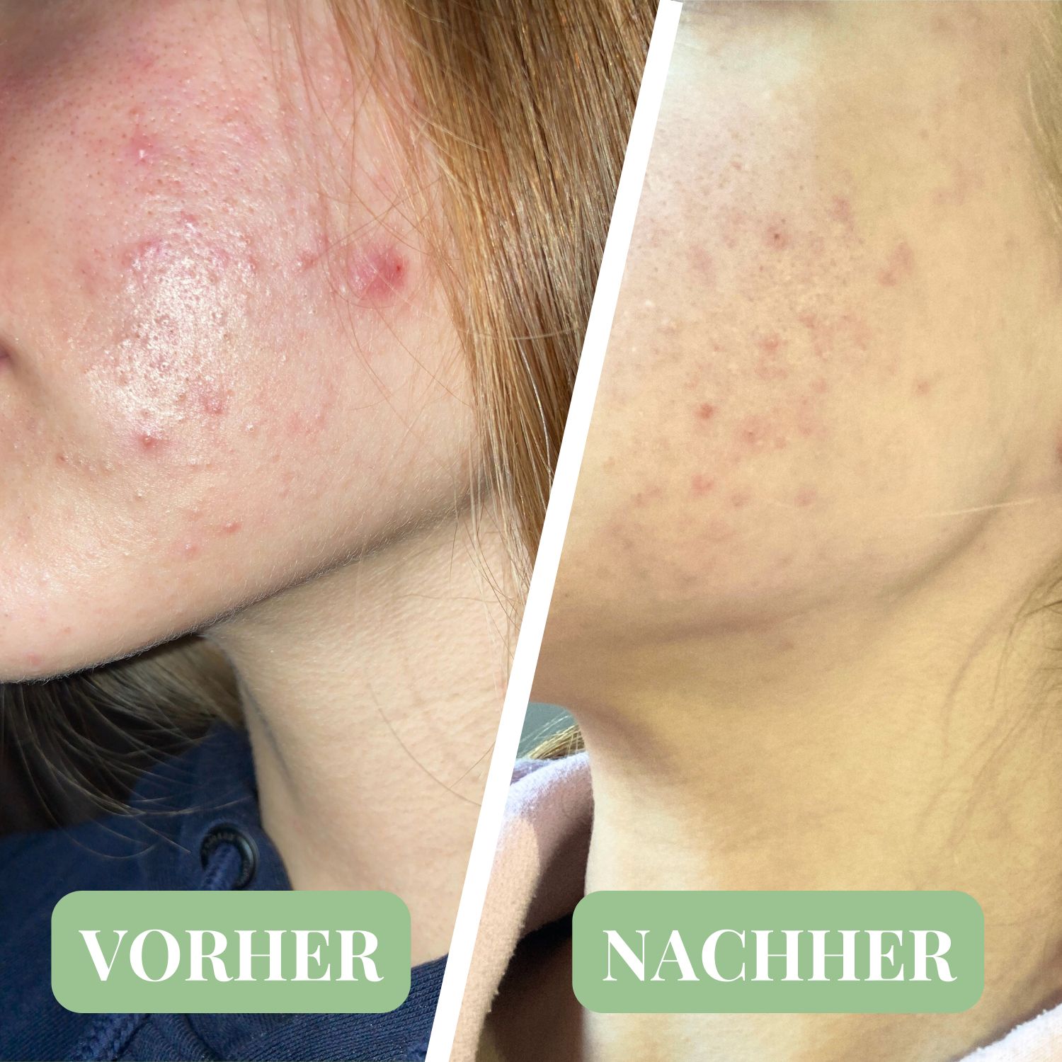 Vorher-Nachher-Vergleich. Gesicht mit Akne, dann verbessertes Hautbild. Text: Vorher, Nachher.
