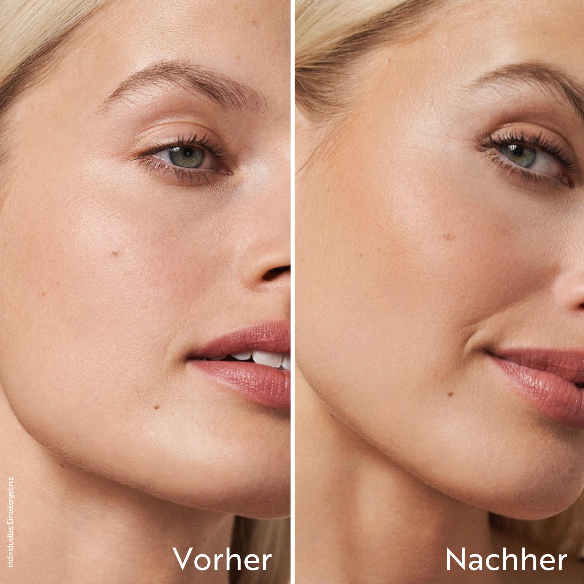 Gesichtshälfte vor und nach der Anwendung. Links: Vorher. Rechts: Nachher. Haut wirkt ebenmäßiger und gebräunter.