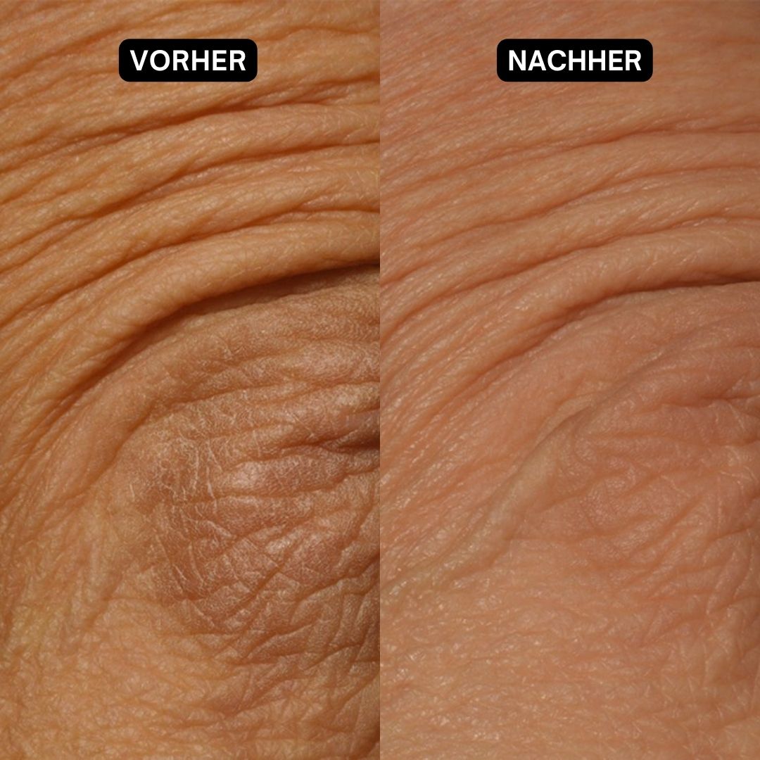 Vorher-Nachher-Vergleich von Haut. Links: faltige Haut. Rechts: glattere Haut.