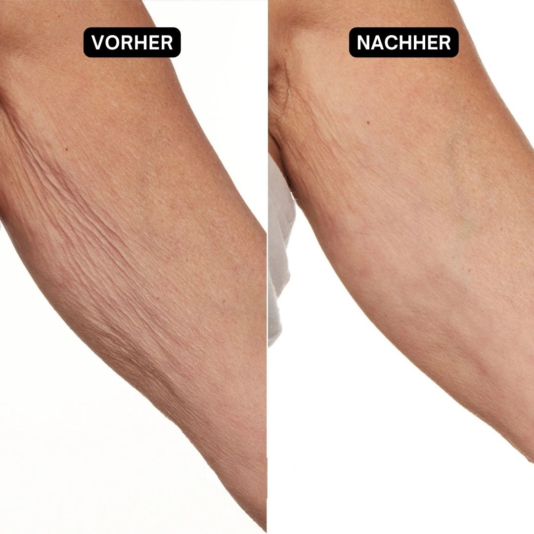 Zwei Arme, einer mit faltiger Haut, der andere glatt. Text: Vorher/Nachher.