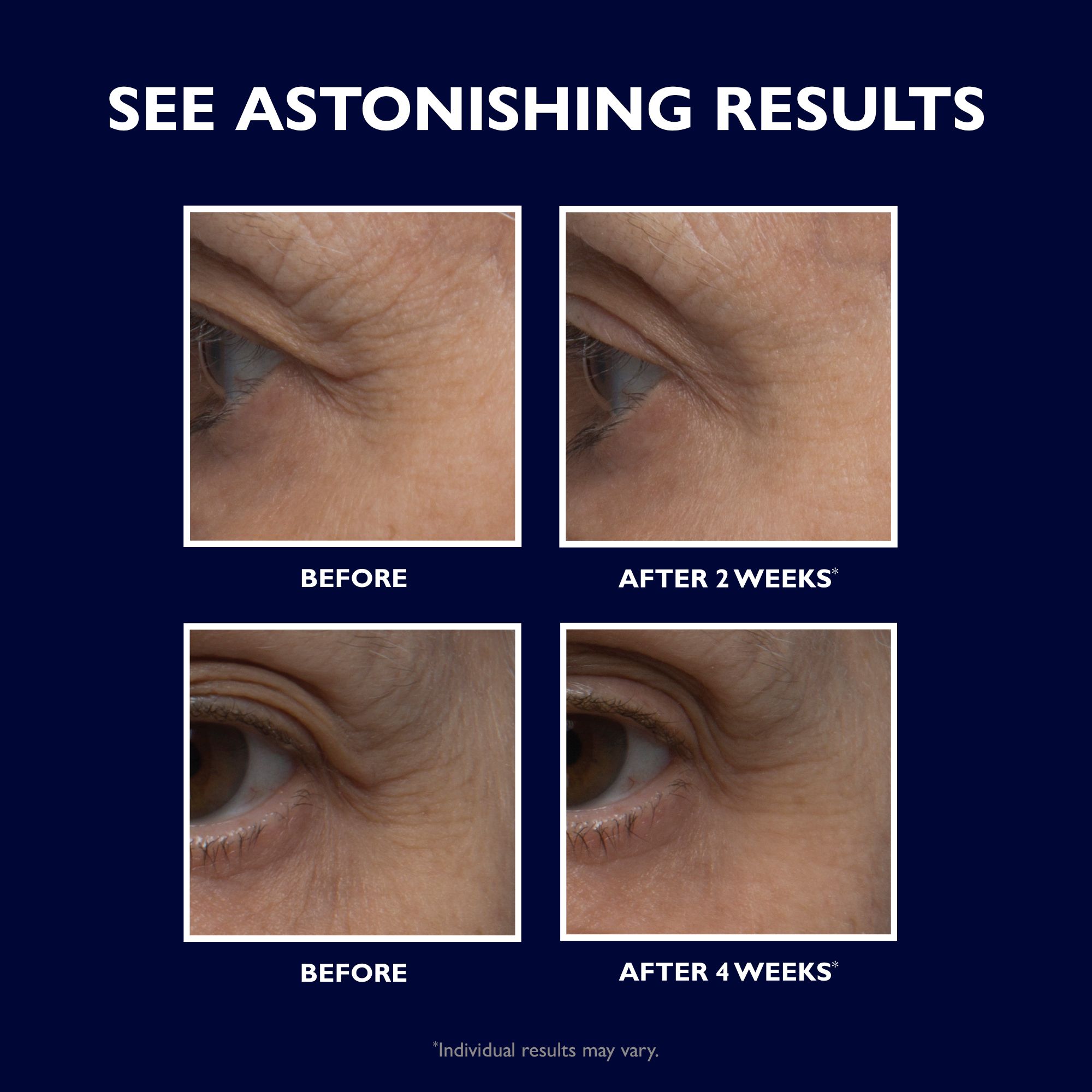 Vier Nahaufnahmen von Augenpartien. Vorher/Nachher-Vergleich. Beschriftung: Before, After 2 Weeks, After 4 Weeks.