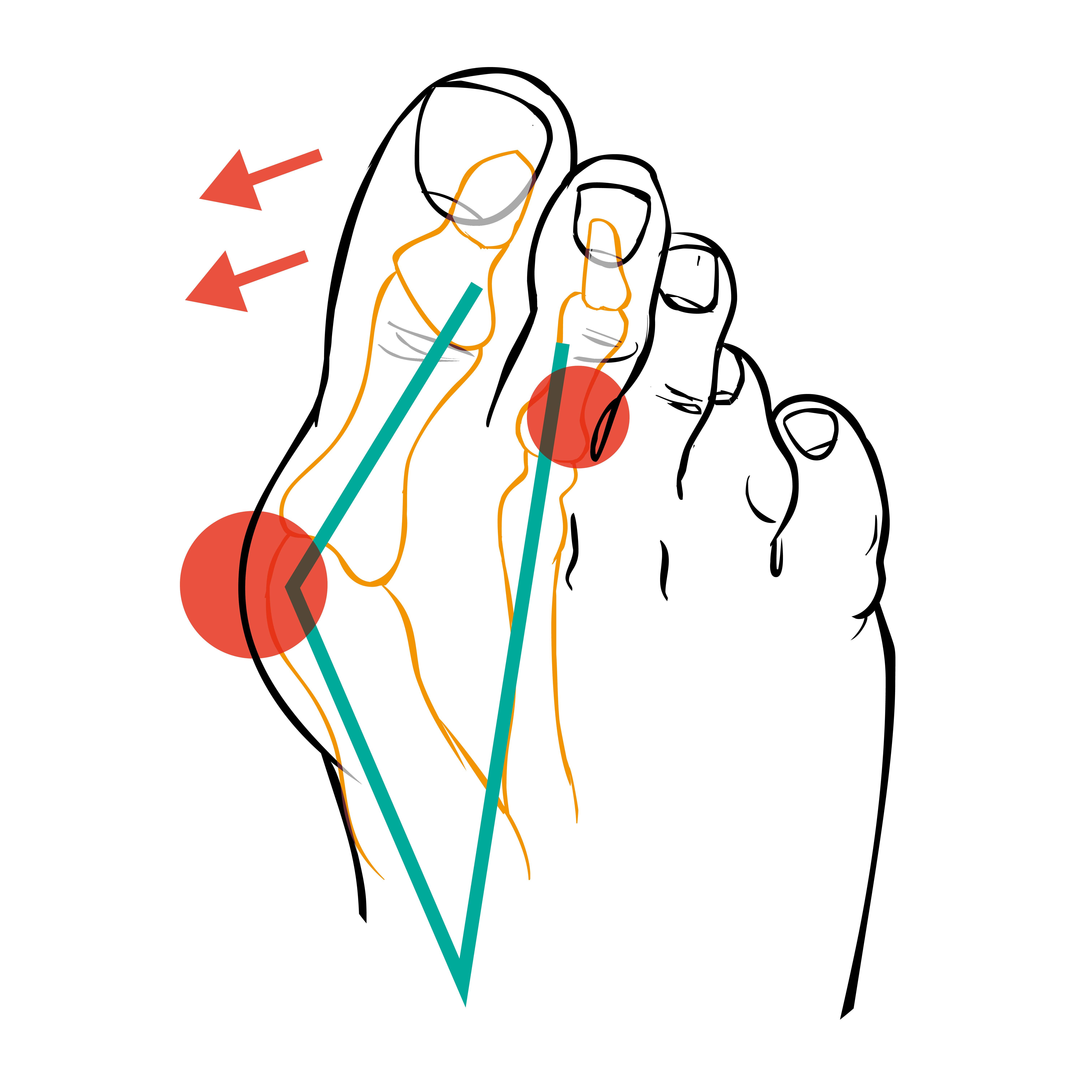 Fuß-Illustration mit farbigen Markierungen und Pfeilen, die den Hallux Valgus darstellen.