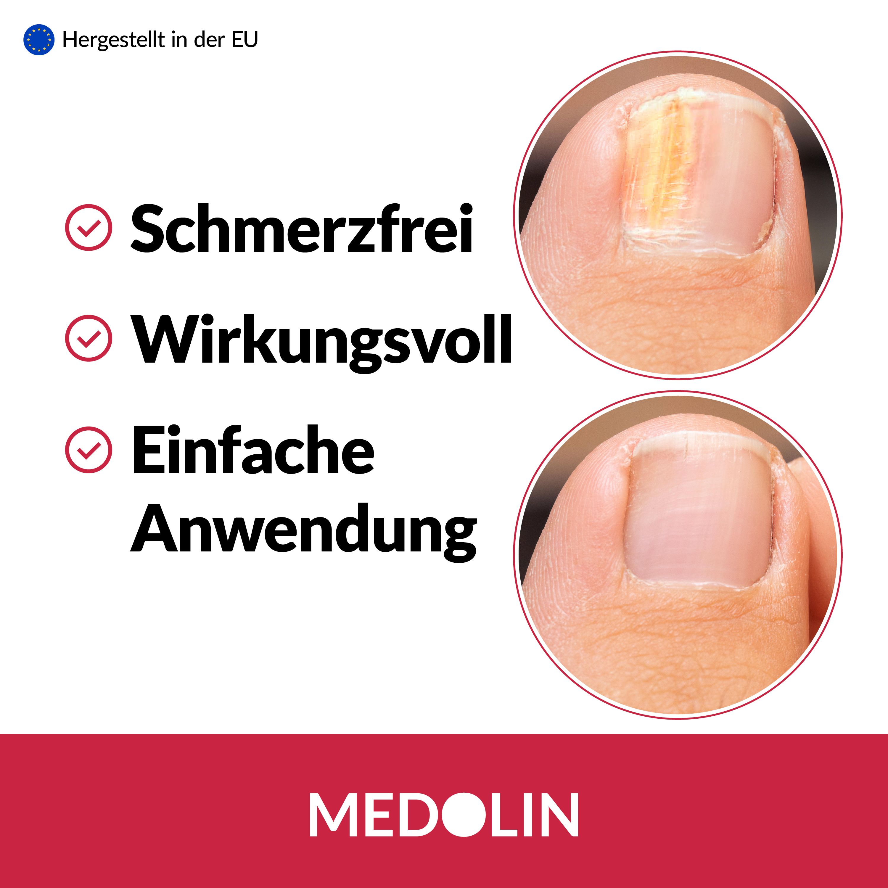 Medolin Nagelpilz Lösung: Vorher-Nachher-Vergleich eines infizierten Nagels. Schmerzfrei, wirkungsvoll, einfache Anwendung.