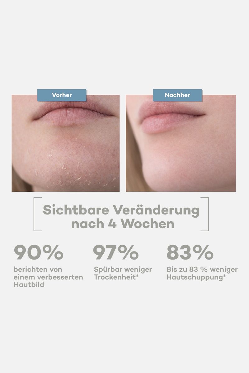 Vorher-Nachher-Vergleich von Lippen. Text: Sichtbare Veränderung nach 4 Wochen. Prozentangaben zu Hautbild und Trockenheit.