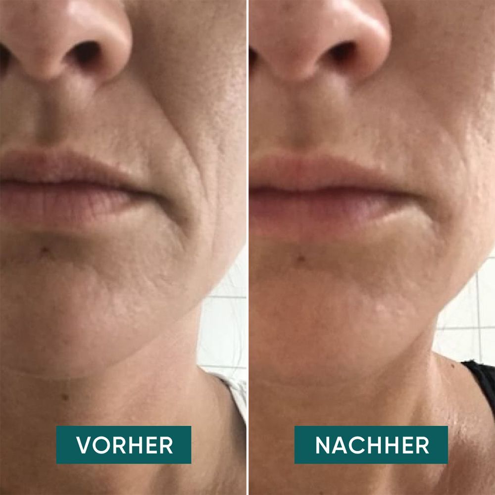 Vorher-Nachher-Vergleich. Hautpartie mit Falten, dann glattere Haut. Beschriftung: Vorher, Nachher.