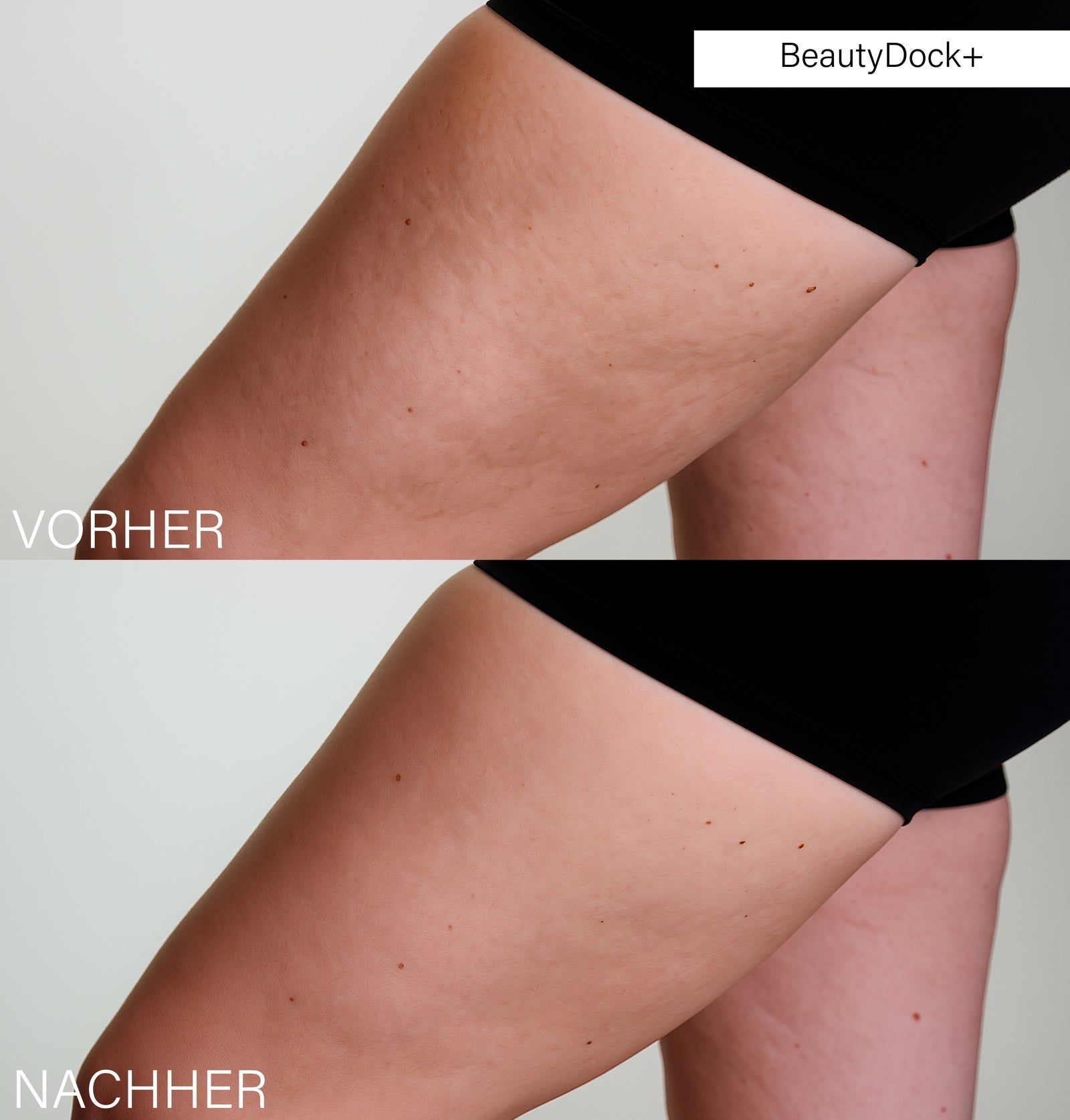 Vergleich von Oberschenkeln: Vorher und Nachher. BeautyDock+ beschriftet. Hautbild mit Cellulite, dann glatter.