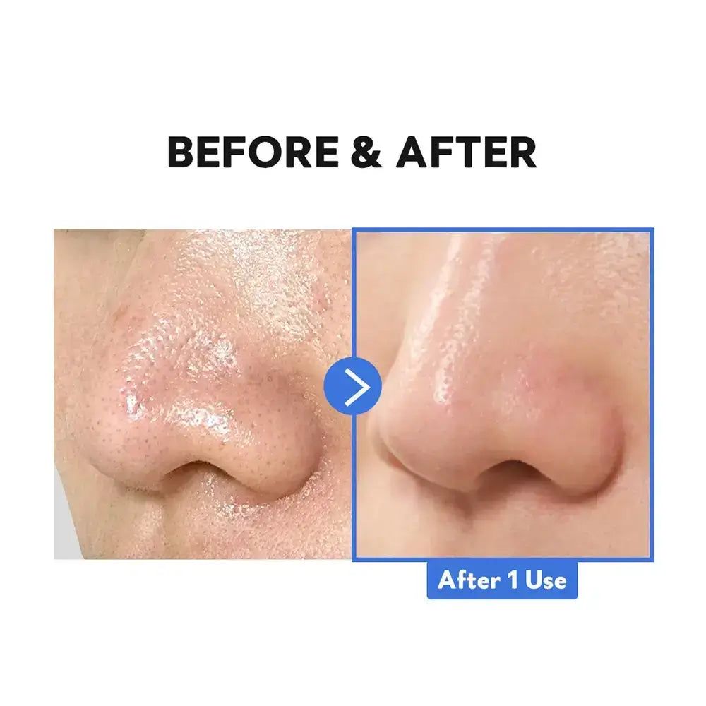 Vorher-Nachher-Vergleich der Nasenporen, die nach der Anwendung des TIRTIR Hydro Boost Enzyme Reinigungsbalsams verfeinert sind.