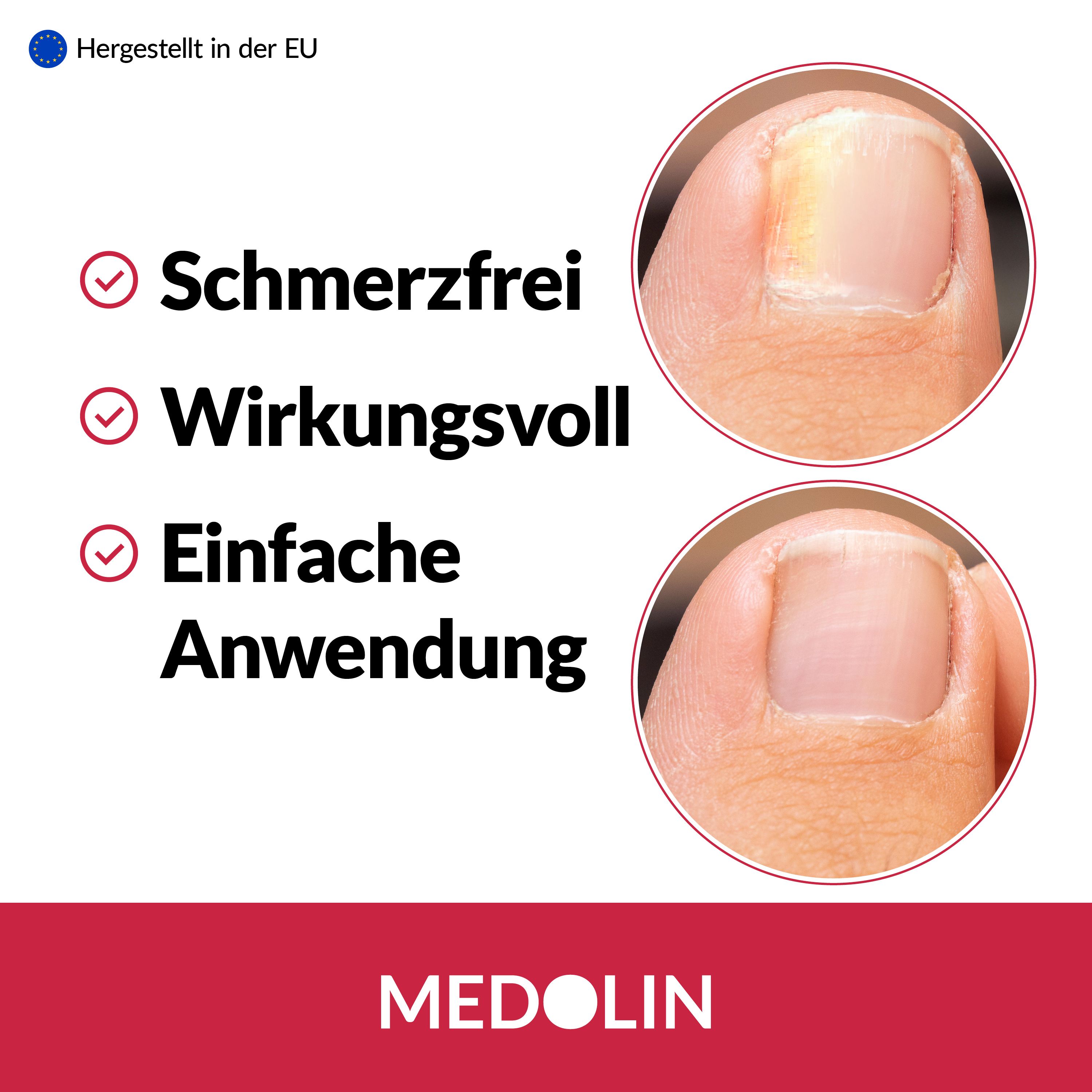 Medolin Nagelpilz Lösung: Vorher/Nachher-Vergleich gesunder Nagel. Schmerzfrei, wirkungsvoll.