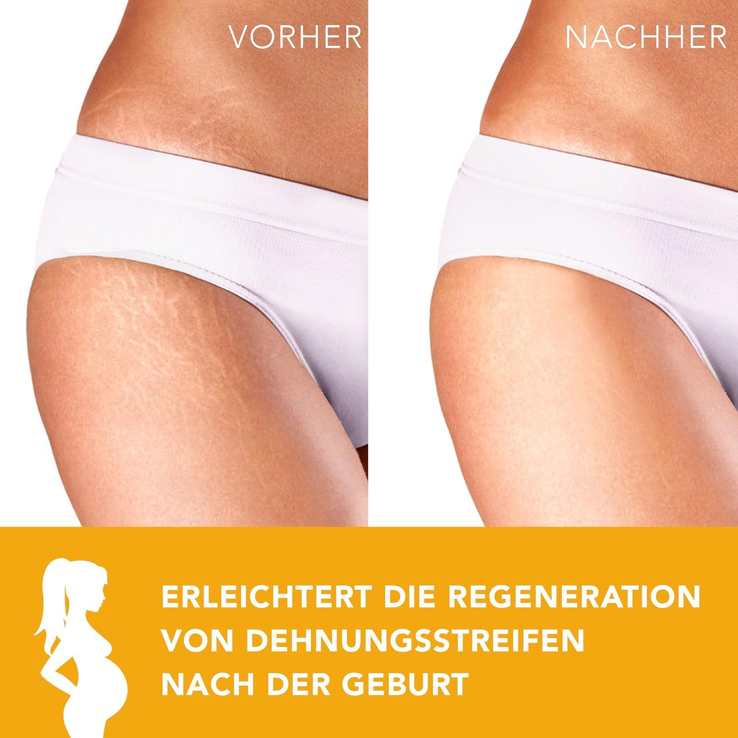 Vorher-Nachher-Vergleich von Dehnungsstreifen nach der Geburt, die durch ein Produkt verbessert wurden.