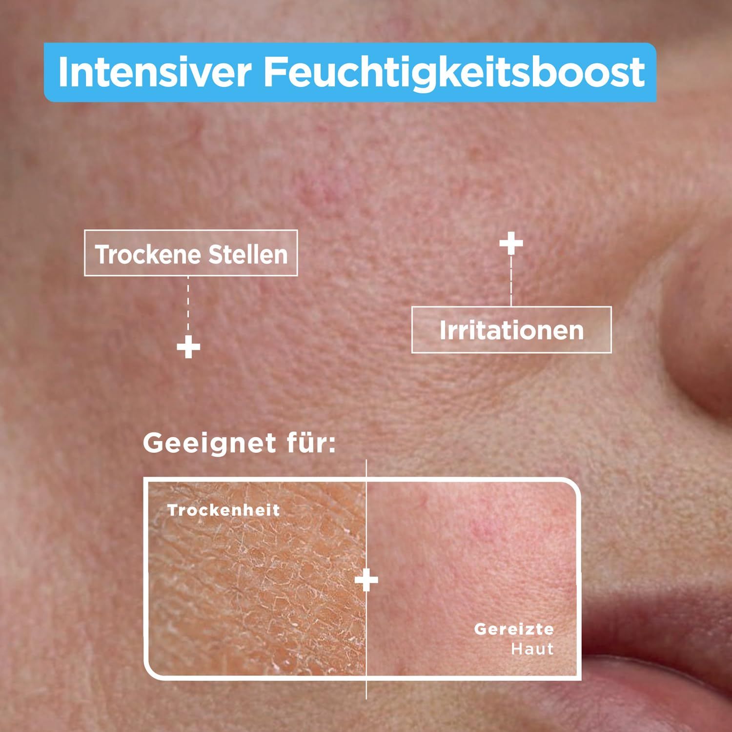 Nahaufnahme von Haut mit Trockenheit und Irritationen. Text: Geeignet für Trockenheit und gereizte Haut. Intensiver Feuchtigkeitsboost.