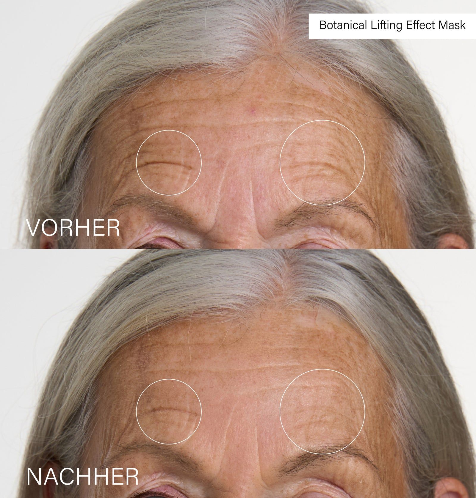 Vergleich von Stirnfalten vor und nach der Anwendung. Kreise markieren die Bereiche. Text: Vorher und Nachher.