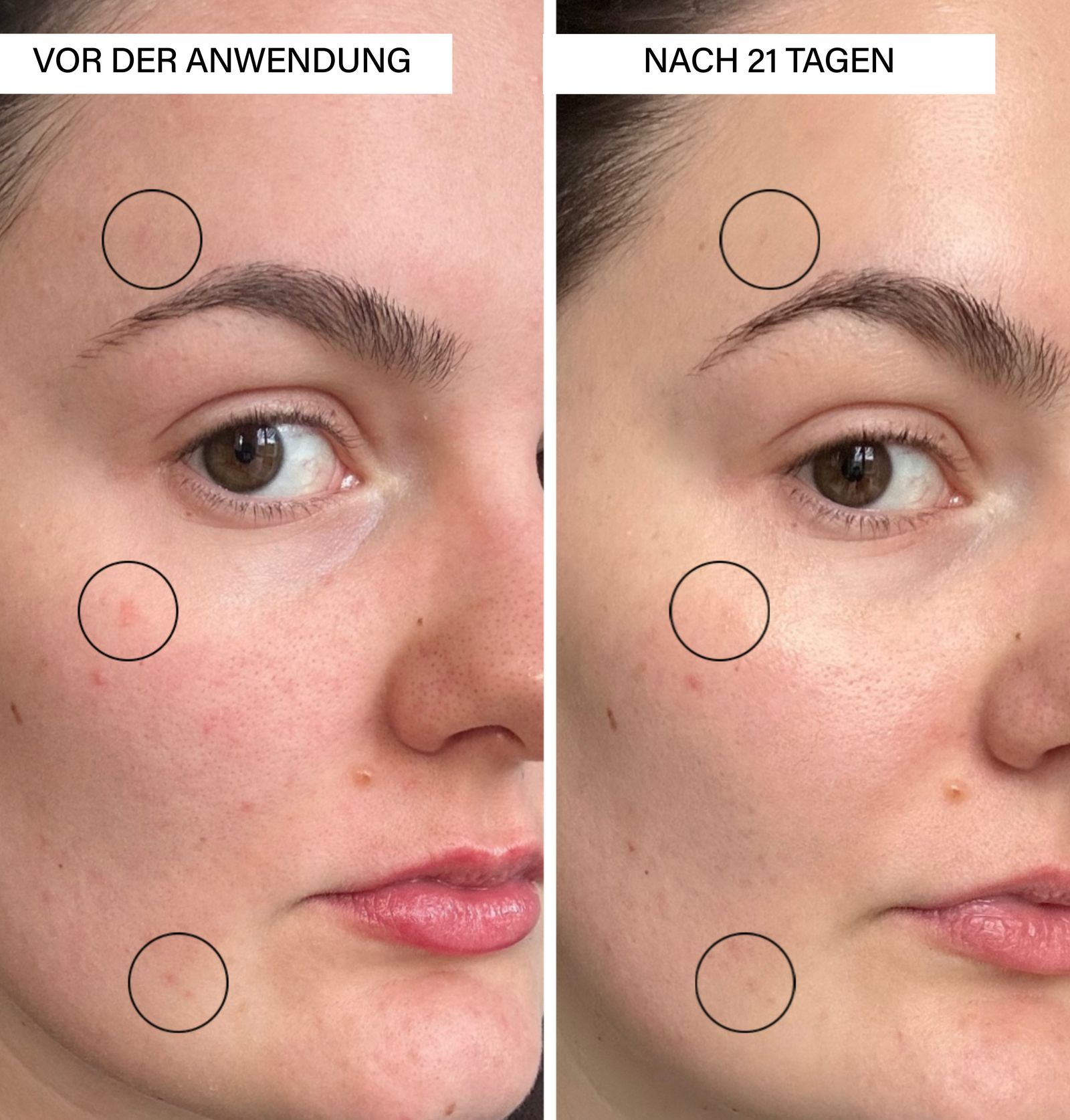 Gesicht, geteilt in Vorher und Nachher. Kreise markieren Hautstellen. Text: Vor der Anwendung, Nach 21 Tagen.