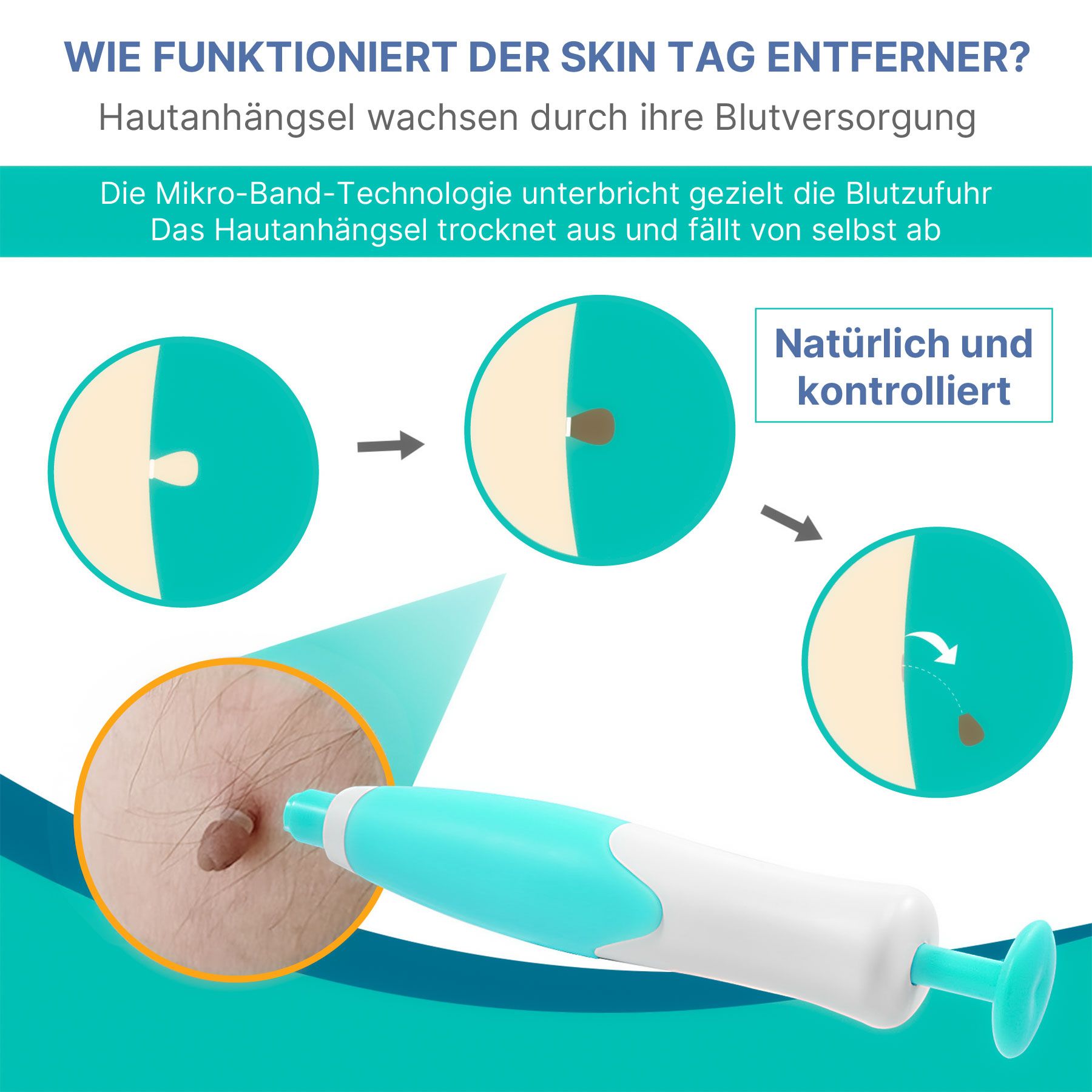 ALIVER Warzen-Behandlungsstift Entferner Skin Tag Removal Set 2in1 Anti Warzenentferner