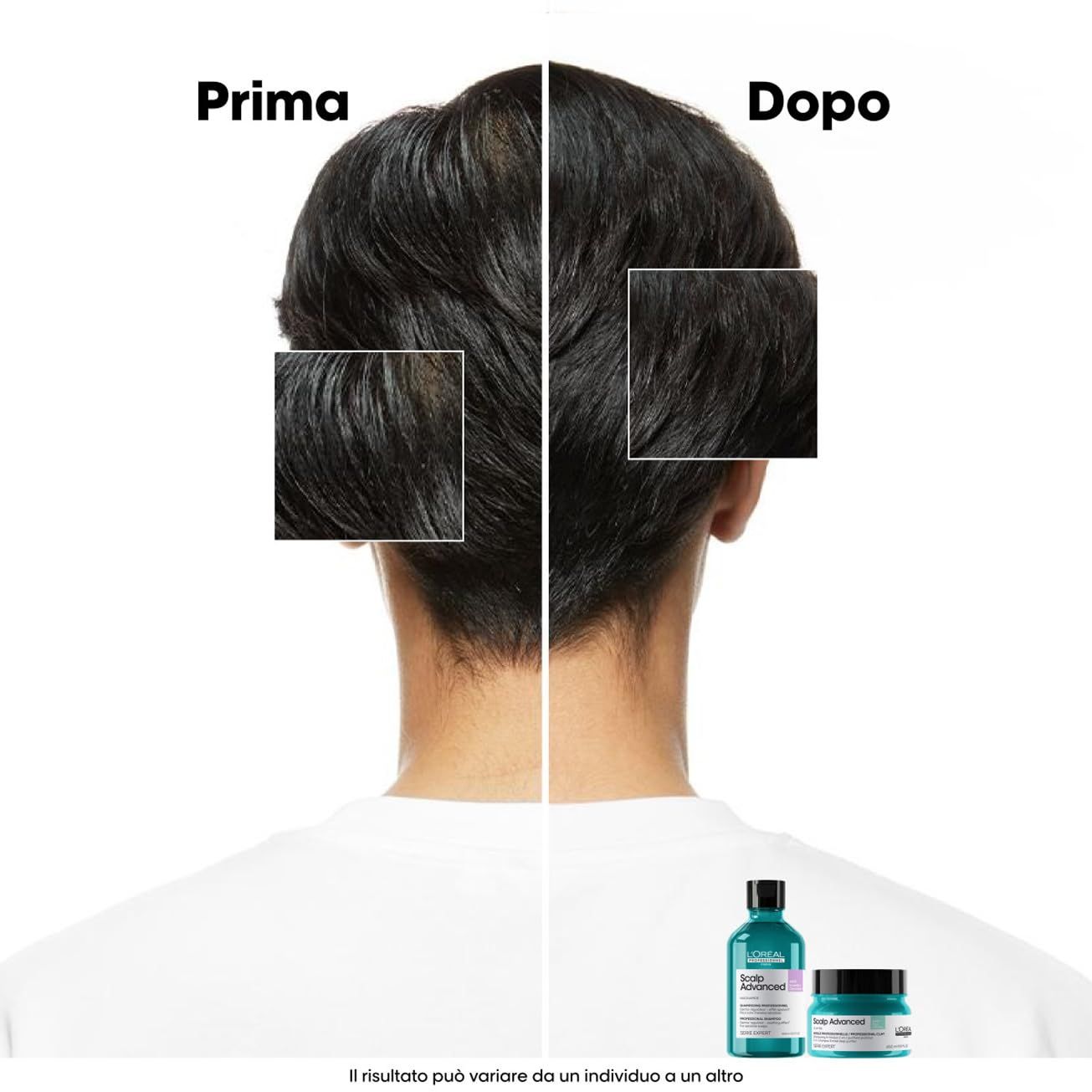 Vorher-Nachher-Vergleich von Kopfhaut und Haaren. Unten: Shampoo und Creme. Text: Prima, Dopo. L'Oréal Professionnel Scalp Advanced.