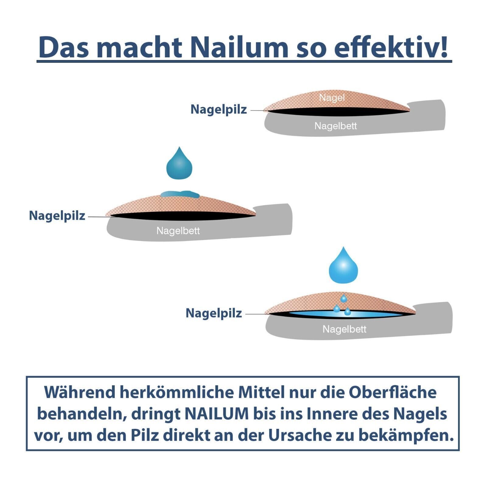 Nalium Anti Nagelpilz-Behandlungsstift