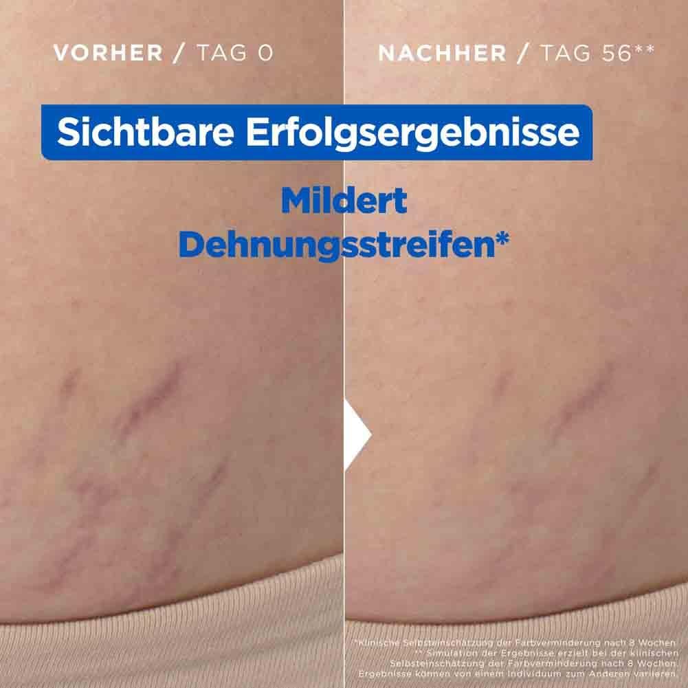 Bauchpartie mit Dehnungsstreifen. Vorher/Nachher-Vergleich. Text: Sichtbare Erfolgsergebnisse. Mildert Dehnungsstreifen.