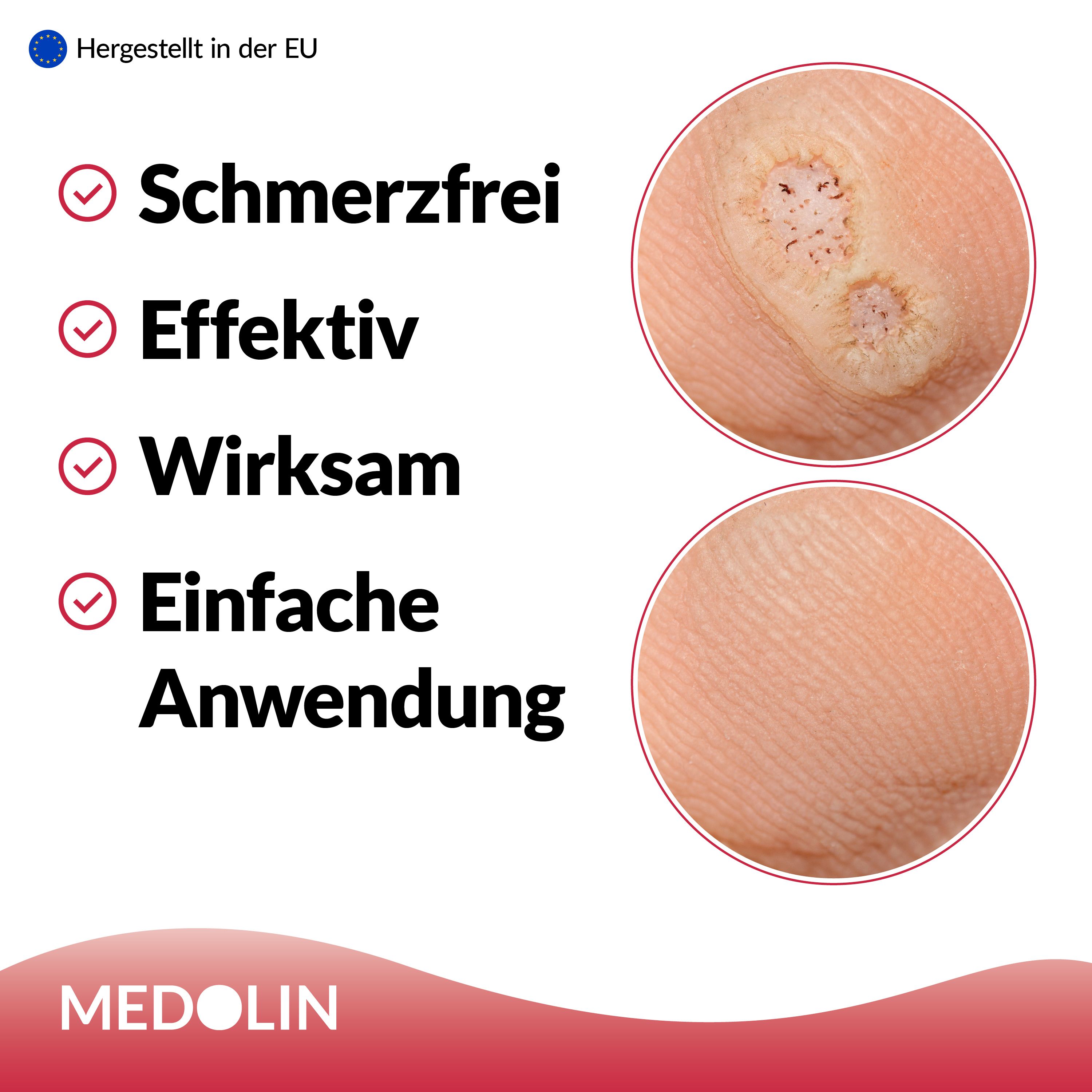 Medolin® Dornwarzen Pflaster