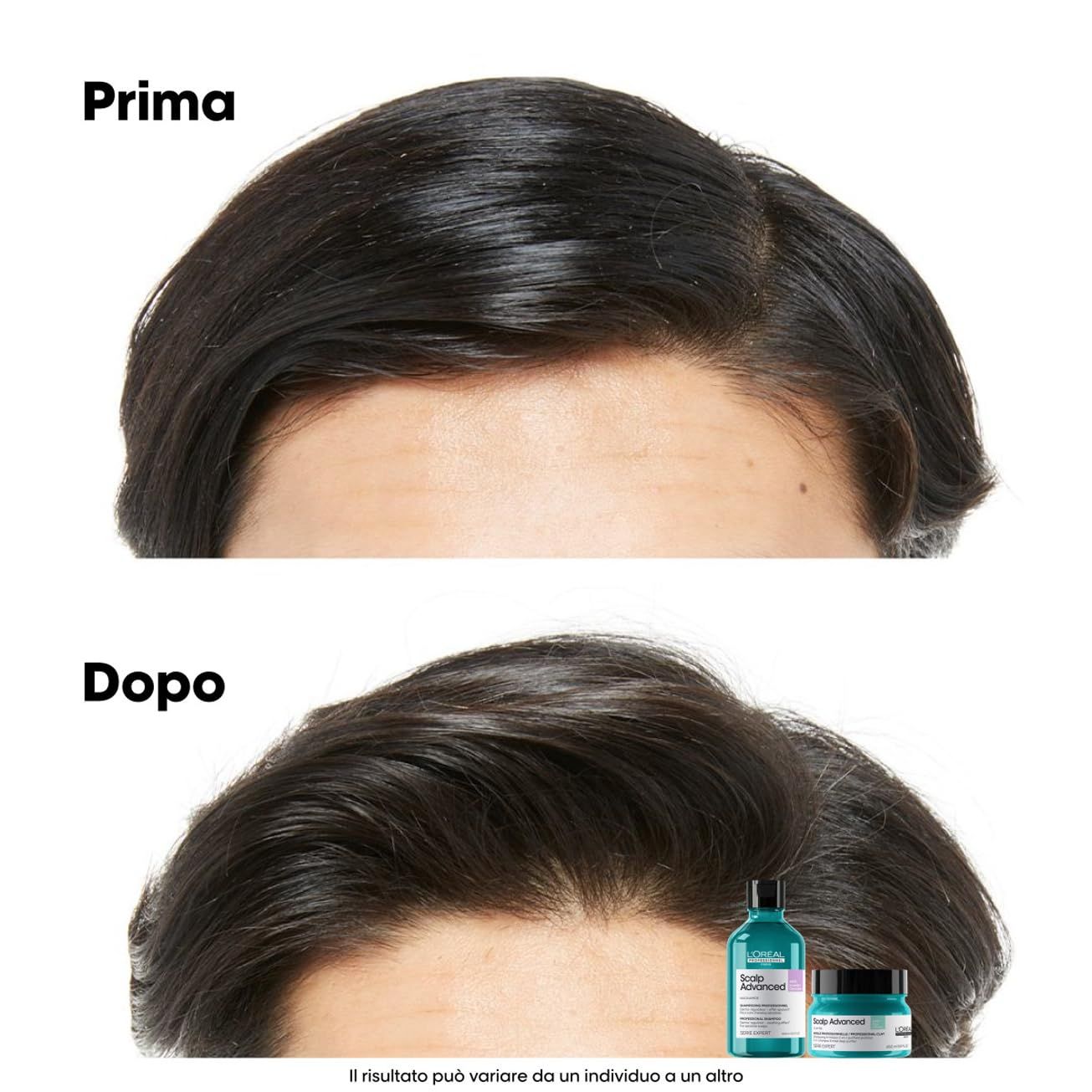 Vorher-Nachher-Vergleich von Haaren. Unten: Shampoo und Creme. Text: Prima, Dopo. L'Oréal Professionnel Scalp Advanced.