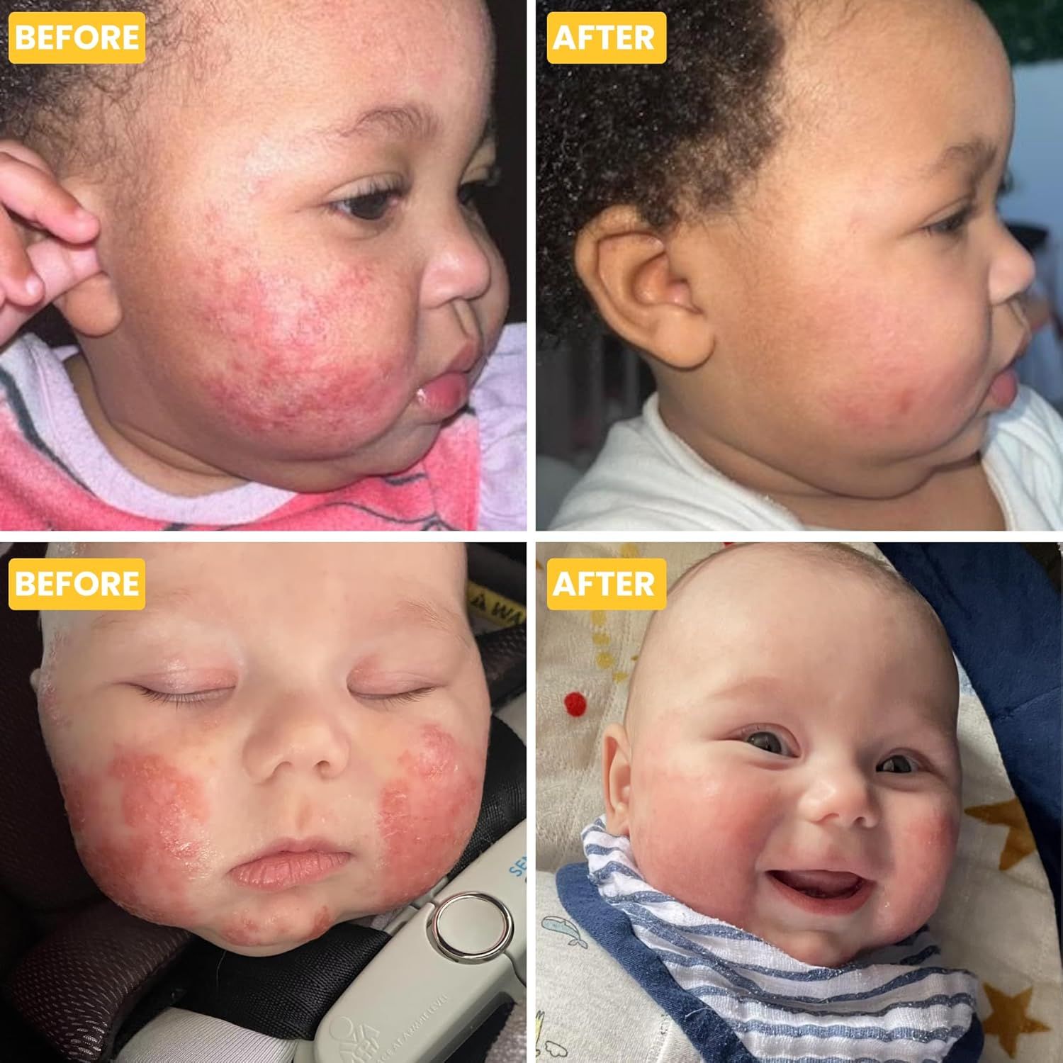 Vorher-Nachher-Bilder von Babys mit Ekzemen. Hautrötungen vor und nach der Anwendung der Creme.